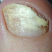 Mykóza nehtů na palci u nohy. Autor: Cisco93