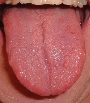 Zvětšené papily na jazyku