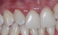 Jak obnovit dásně
