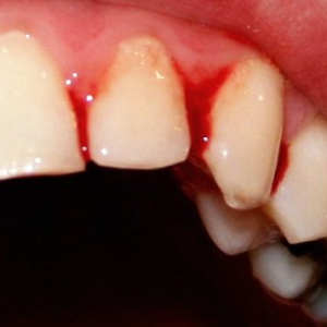 Domácí léčba zánětu dásně