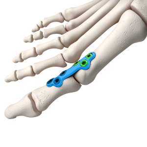 Artrodéza palce nohy