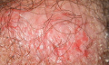 Lupénka ve vlasech - léčba pomocí přírodních látek