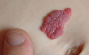 Hemangiomy - nezhoubné kožní nádory