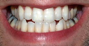 Citlivost zubů