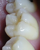 Bolest zubů