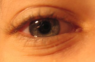 hogyan lehet astigmatizmussal javítani a látásélességet