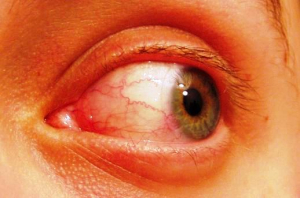 Červené žilky v oku