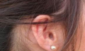 Zalehlé ucho