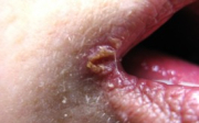 Anguli infektiosi – ústní koutky