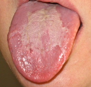 Bílé skvrny na jazyku