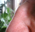 Příčiny studeného nosu