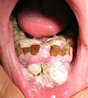 Rakovina v dutině ústní