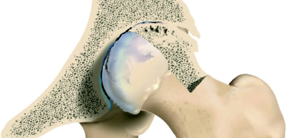 Deformând artroza 2-3 grade a articulațiilor șoldului