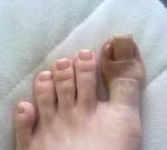 Černání nehtů u palce nohy