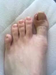 Černání nehtů u palce nohy
