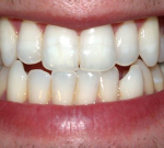 Zánět okostice zubu a zánět dásní