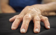Artróza prstů na ruce