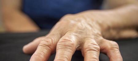 Artróza prstů na ruce